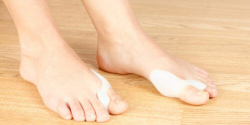 Things You Need to Know about Bunion Treatment