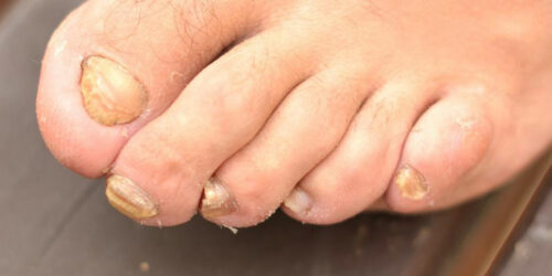 Toenail Fungus &#8211; Causes, Symptoms and Treatment