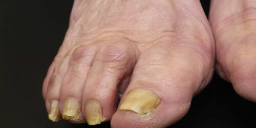 Try These Natural Methods to Cure Nail Fungus