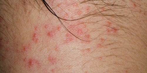 Types of Eczematous Dermatitis and Their Symptoms