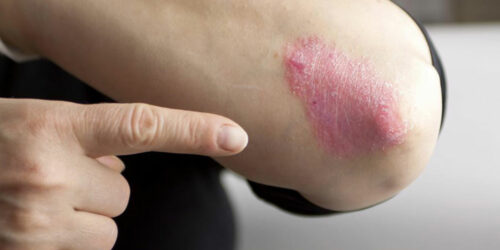 Types and Treatment of Chronic Psoriasis