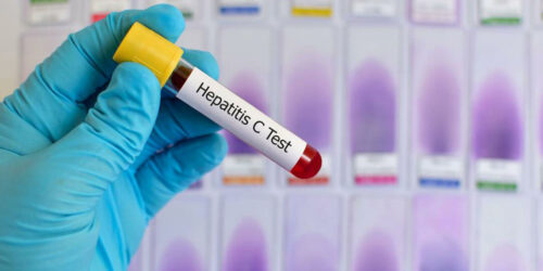 What to Expect from Hepatitis C Treatment