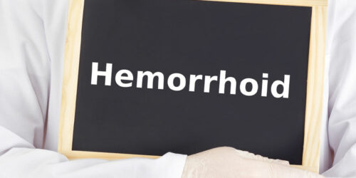 Causes and Treatments of Hemorrhoids