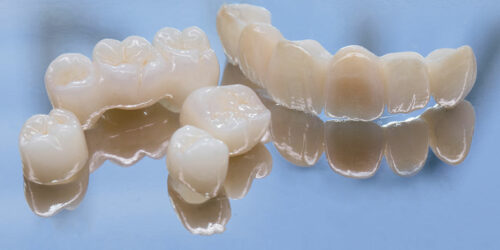 Things to Know Before Opting for Dental Bridges