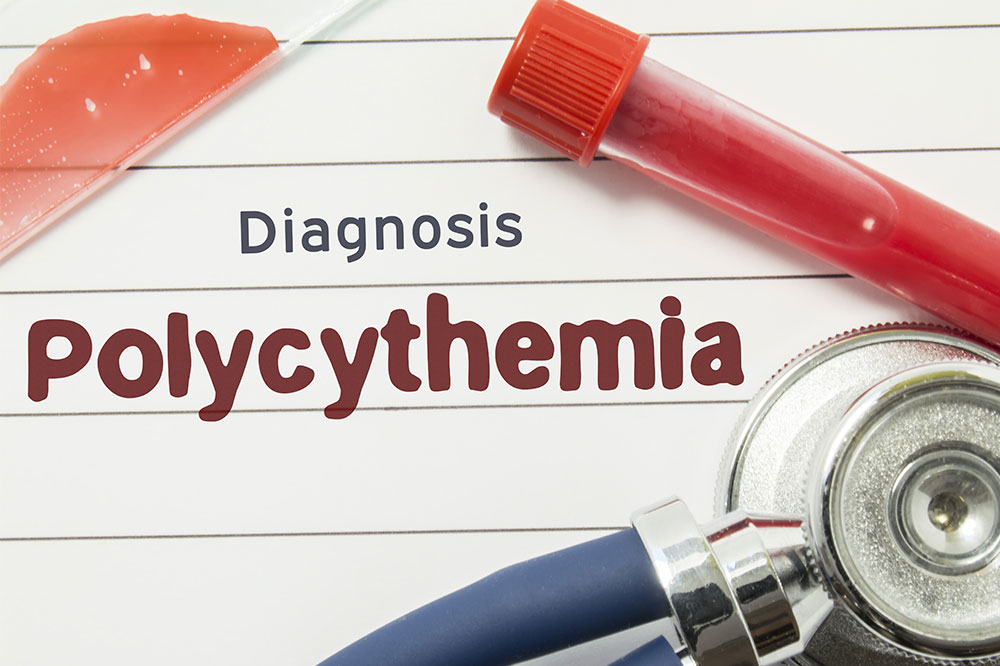 Various Aspects of Polycythemia Vera