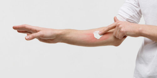 Types and Symptoms of Atopic Dermatitis